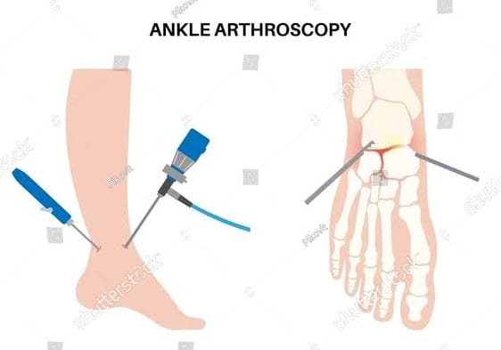 hip, Ankle & Elbow Arthroscopy Image