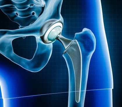 Hip Replacement Image