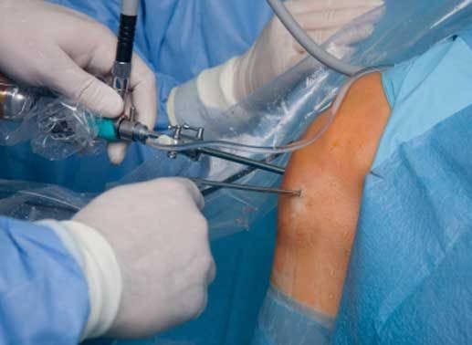 Knee arthroscopy Image