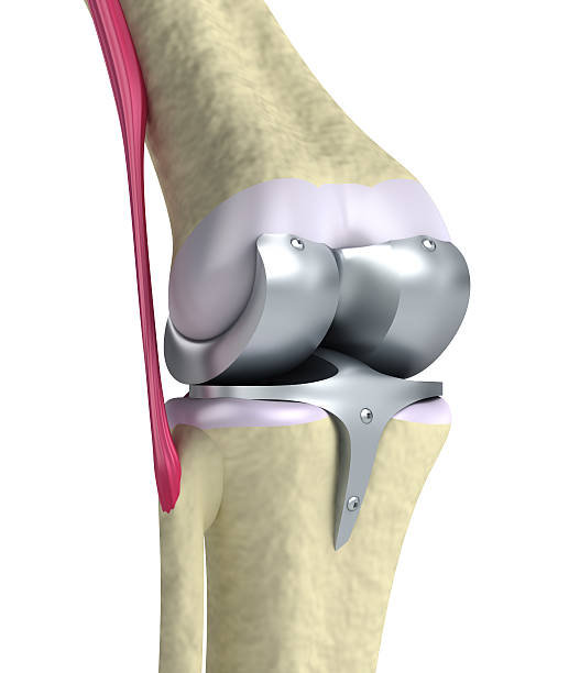 Knee Replacement Image
