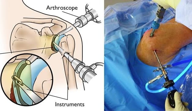 Shoulder Arthroscopy Image